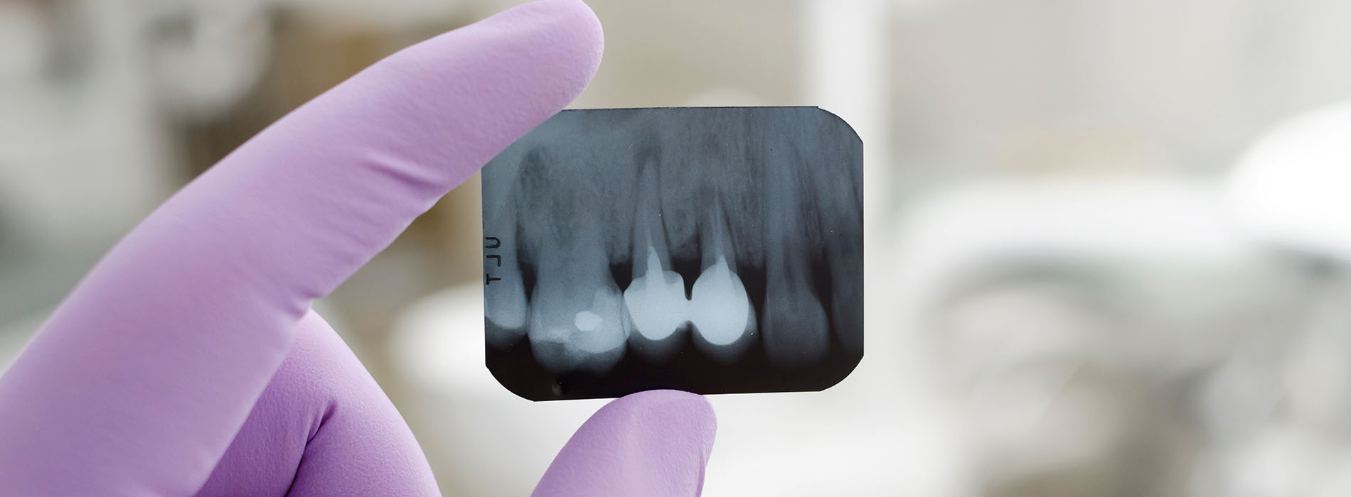The image shows a close-up view of a person s teeth being examined by a dental professional using a magnifying glass, with a focus on the teeth and gums, while wearing gloves and a purple lab coat.